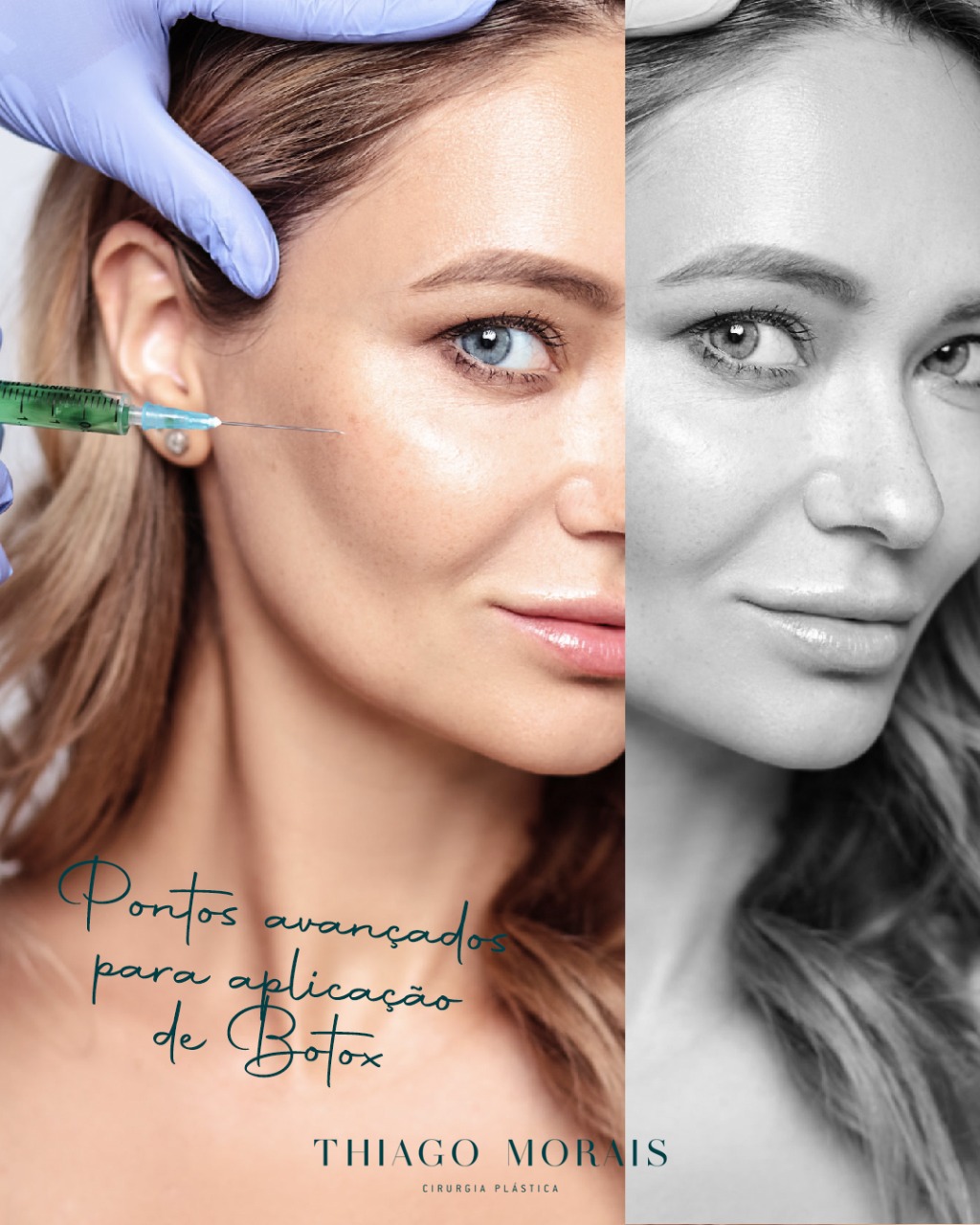 Botox Antes e Depois - Como ter um bom resultado
